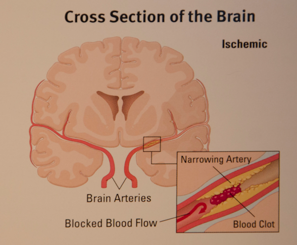 Valley Neurology -      Understanding Stroke